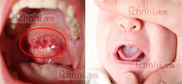 Nguyên nhân &cách trị trẻ bị viêm loét miệng họng hiệu quả